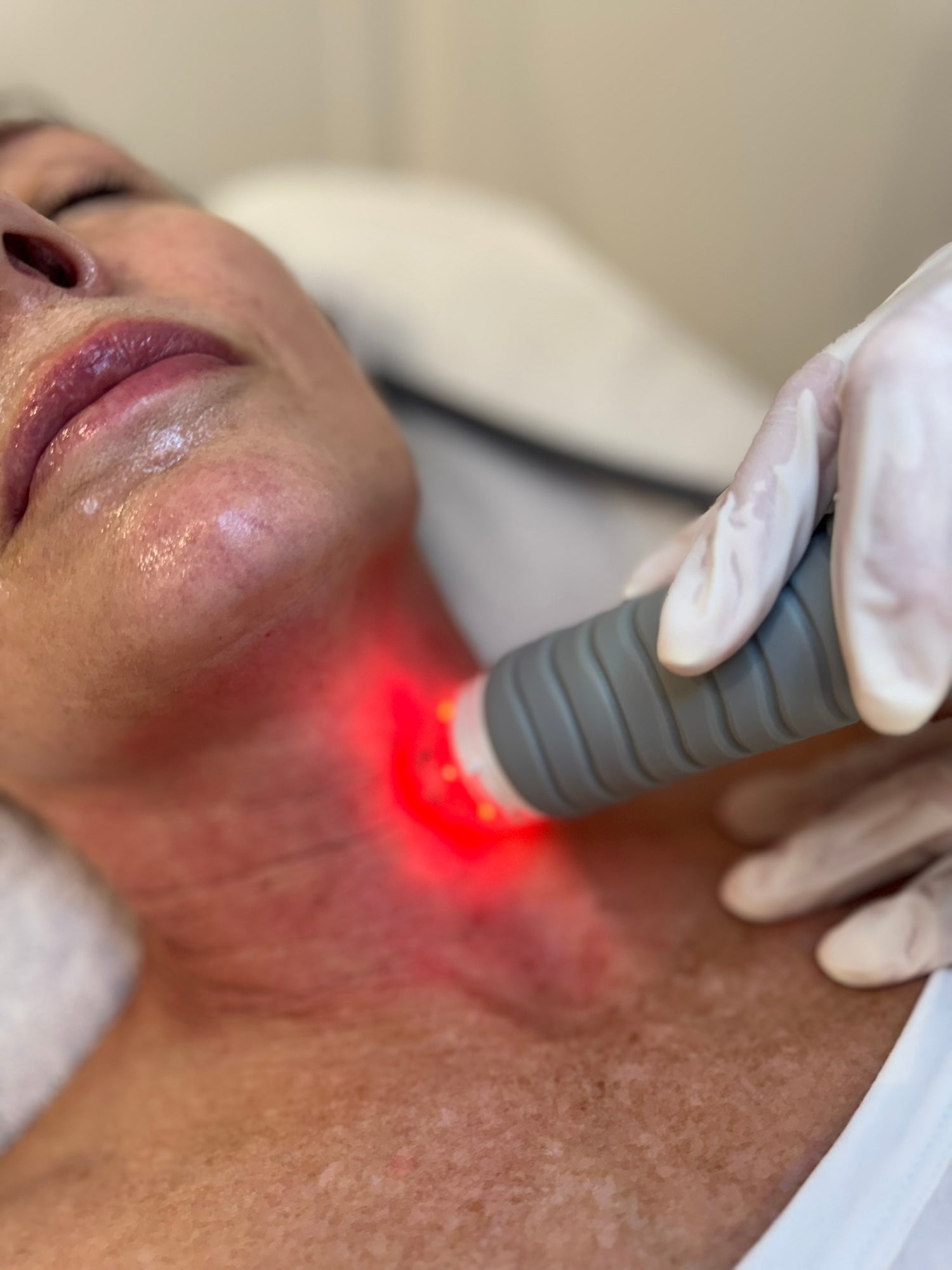 Vivace Microneedling