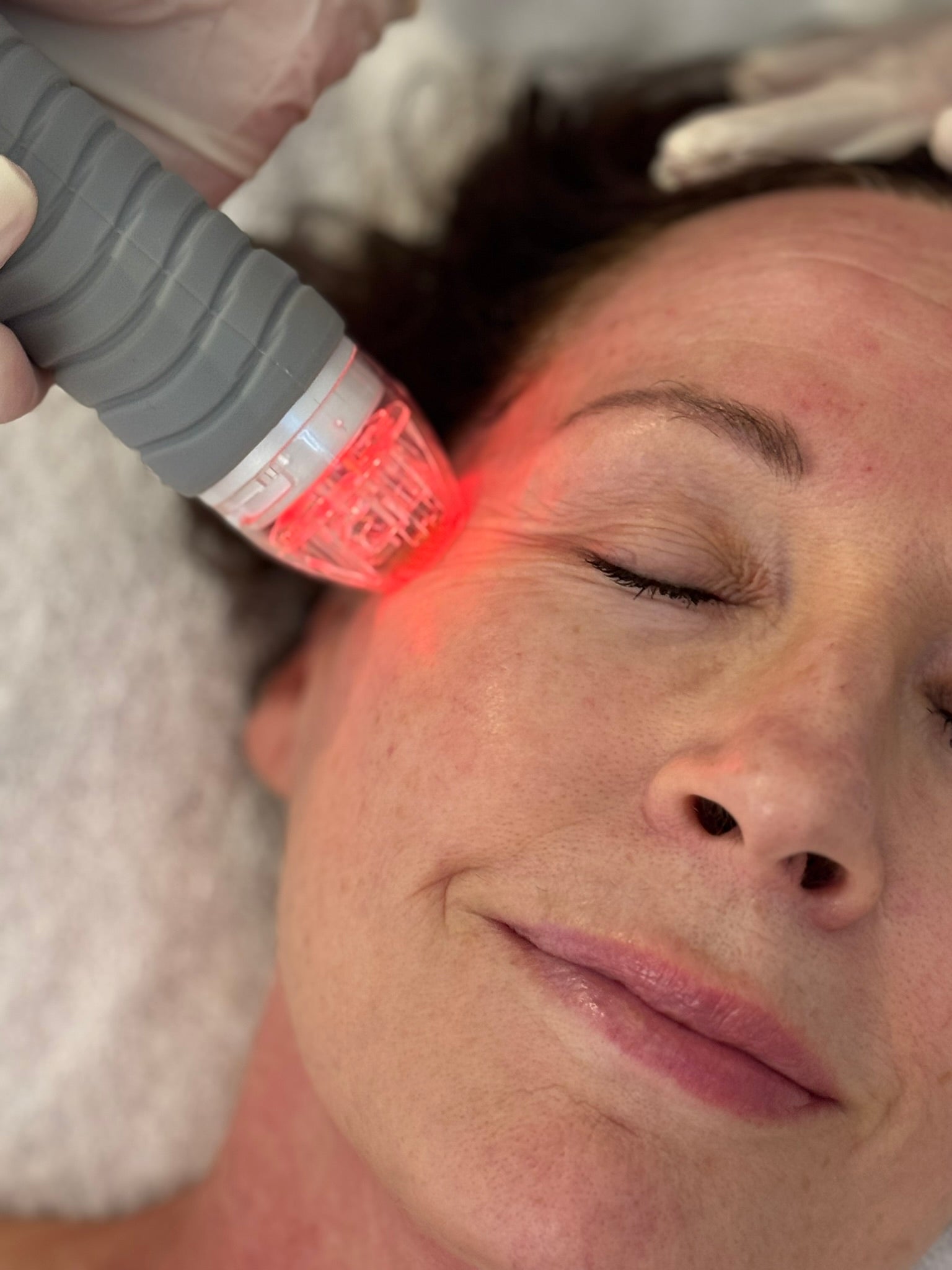 Vivace Microneedling