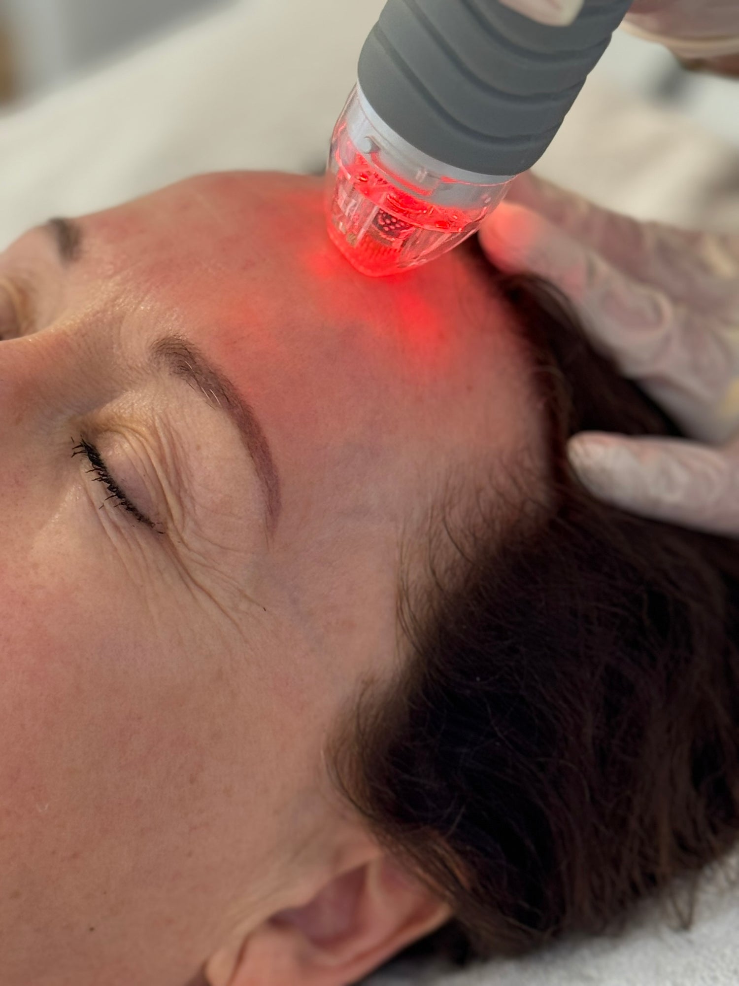 Vivace Microneedling