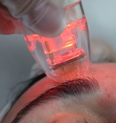 Vivace Microneedling