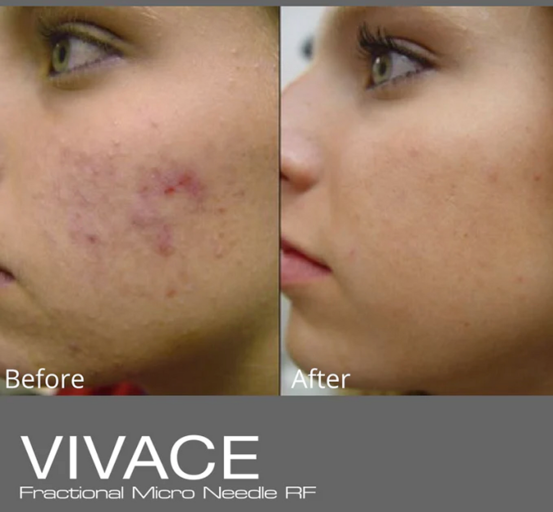 Vivace Winter Skin Renewal Package